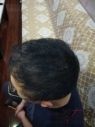  脱发我自己都受不了，我的头发去哪了