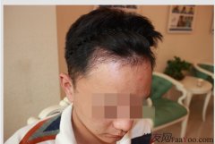 植发中的一些细节瞬间让我感觉很温暖