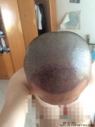 这次植发的决定实在是太正确了