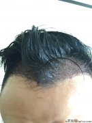 植发，我的死穴终于揭开了