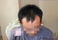 植发真的是从大叔到大哥的节奏啊