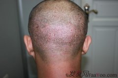  尝试很多办法无效后，只能寄托希望于植发了