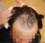 手术出来才发现原来的担心是多余的