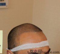 术前和术后，一切感觉都是挺好的