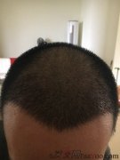 植发需要很大的耐心，希望头发快快长