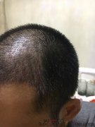 清洗血痂之后整个人的感觉就是不一样