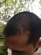 想了很多，最终放弃了犹豫选择了植发