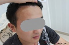 植发经历让我成长了很多