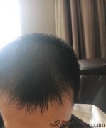  掉头发这些小事情我们往往不会在意