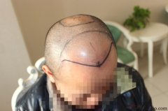 脱发使我一直活在自卑的状态下