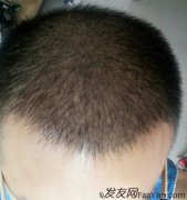 这一次，我的头发应该是真的有救了