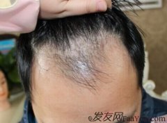  脱发的人生最怕起风时