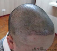 单单脱发的问题就让我苦恼万分