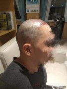 听到头发开始长了我也渐渐看到了希望