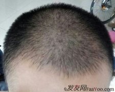  最后还是决定用手术的方式——植发来解决脱发烦恼