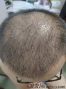 想植发，又怕，犹犹豫豫很久最终还是决定植发
