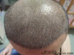 植发不仅让我找回青春，更让我有动力去面对崭新的每一天