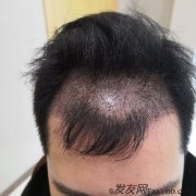 如果植过发，真的会变得不一样，你会变的更好