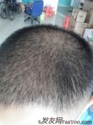 回想起几年前的自己还是一个半秃头的忧郁少年