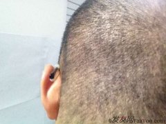 想想植发前后自己的变化，还是挺开心的