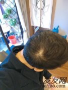 掉头发只知道心疼了，都没明白怎么回事