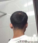 经历了植发手术，我的脱发终于被成功治愈