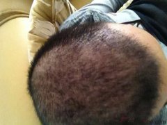 植发手术帮助你换一个人生