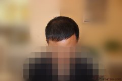 植发手术终于让我终于摆脱了脱发生涯