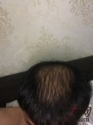 苏玫氏头发纤维粉，终于找到了方法