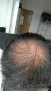渐少去的头发，让我自信也逐渐的流失