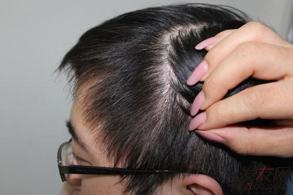 做完植发手术后头发能保持多久？
