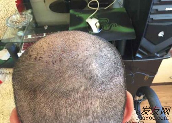 做完植发手术后头发能保持多久？