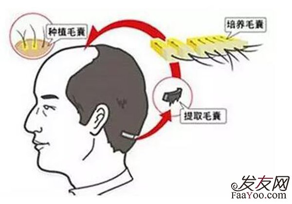 植发也会产生副作用吗?