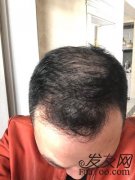  我生命中的一道亮光——头发纤维粉