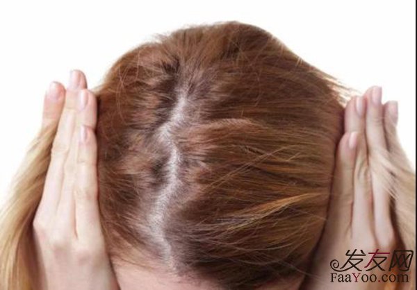 通常产后脱发多长时间能恢复？