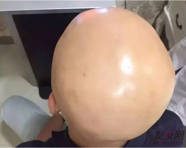 生活中防脱发有哪些好方法?