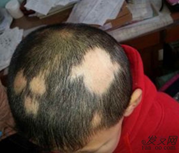 突然出现斑秃该怎么办?