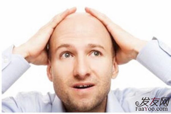男性脱发应该怎样预防?