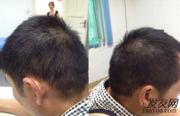 为什么男性比女性更容易掉头发?