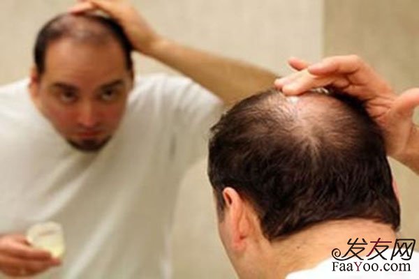 针对男性脱发，常用到的三种方法