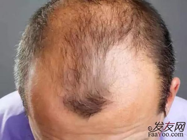M型发际线和脱发有区别吗?