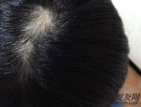 脂溢性脱发了那还有救吗?