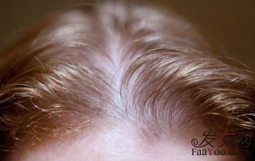 脂溢性脱发可以彻底治好吗？