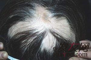 头发既油又痒是什么原因导致的？