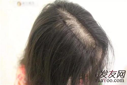 女性脂溢性脱发食疗方法有哪些?