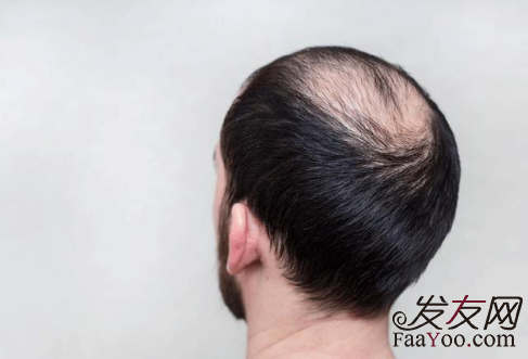 年青男性脱发能治好吗?
