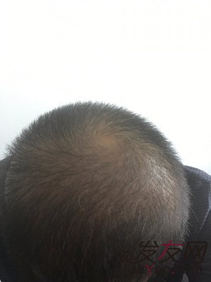 苏玫氏头发纤维粉