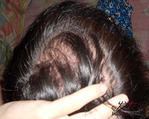 脂溢性脱发如何做才能生发呢