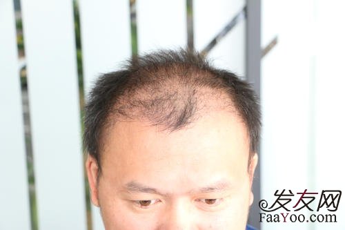 遗传性脱发可以有效的预防吗?