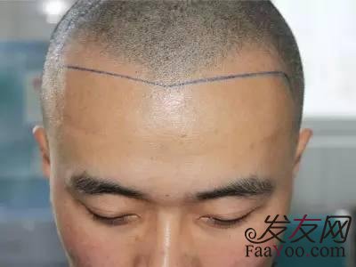 雄性激素脱发常常表现为什么症状?